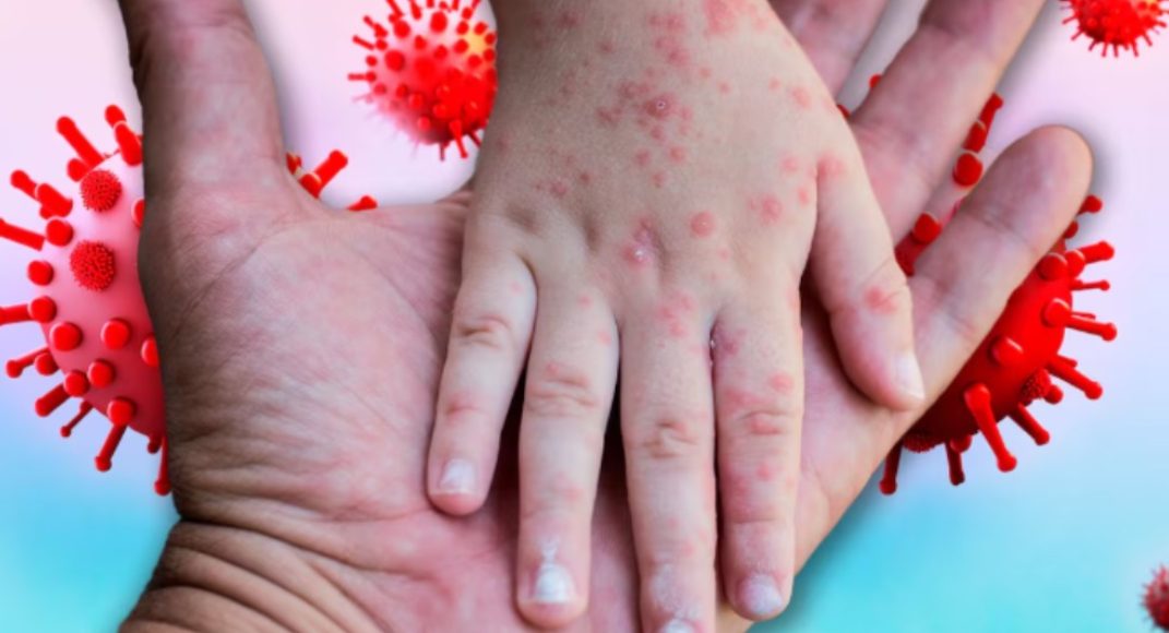 Chihuahua suma 713 casos de sarampión, un incremento alarmante que requiere atención urgente.