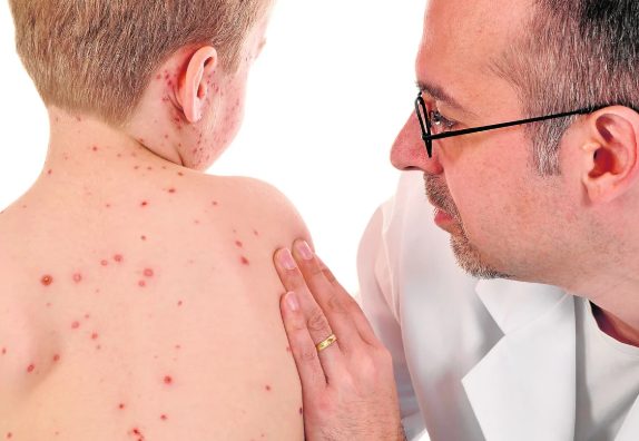 La Secretaría de Salud refuerza la vigilancia epidemiológica ante el alarmante aumento de muertes por tosferina y sarampión en el país.