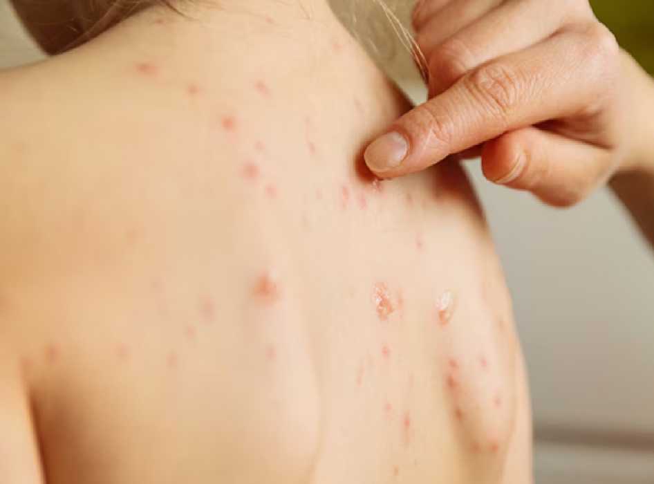 Vigilancia sanitaria intensificada en Bacalar por sarampión.