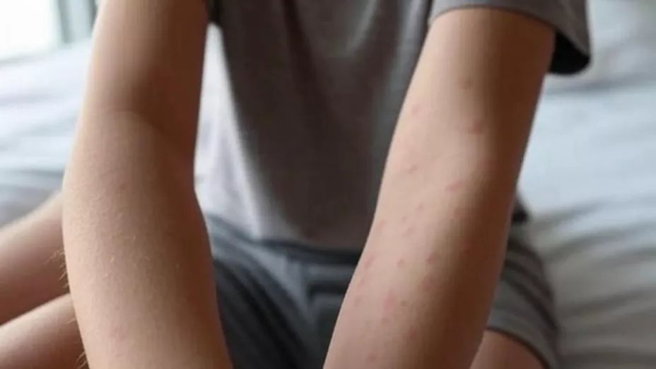 Impacto del sarampión en México y la necesidad de una alerta.