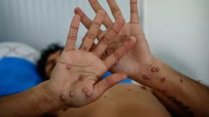 Primera muerte por viruela del mono en Quintana Roo: joven de 24 años fallece en Cancún con complicaciones y múltiples padecimientos.