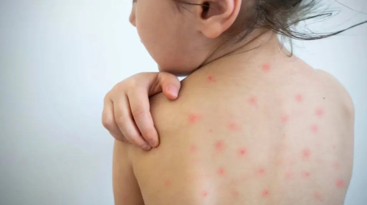 Casos de varicela en aumento en Quintana Roo, afectando principalmente a menores.