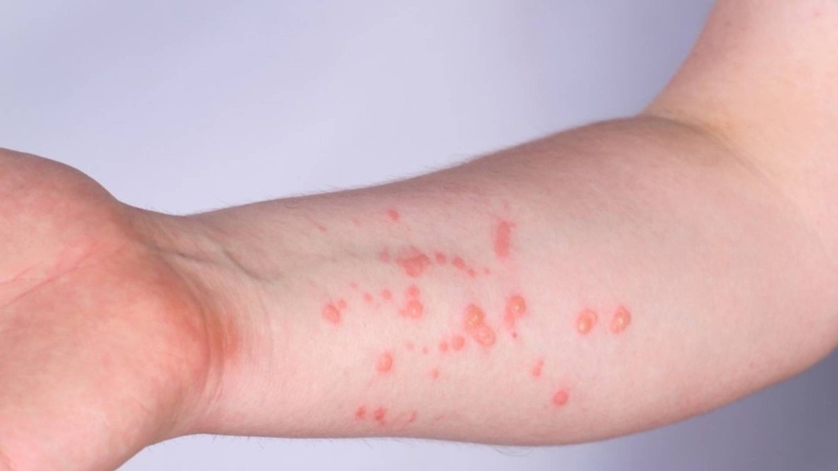 Quintana Roo encabeza la Península de Yucatán con cinco casos confirmados de viruela símica