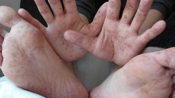 La enfermedad de manos, pies y boca es causada por el virus de Coxsackie y se manifiesta con lesiones cutáneas.