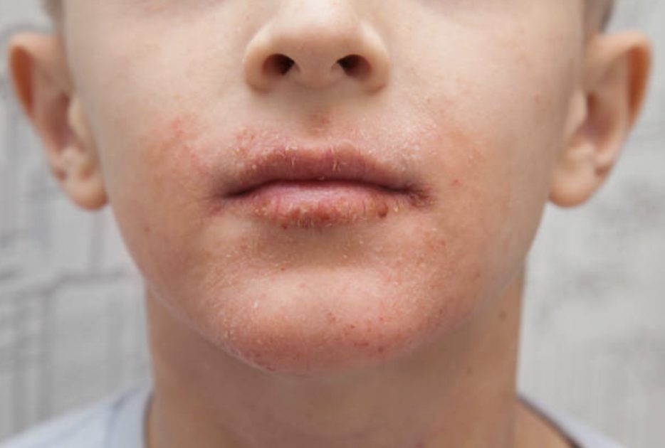 El clima cálido de Quintana Roo intensifica la psoriasis, lo que agrava el bullying escolar y requiere atención integral de salud.