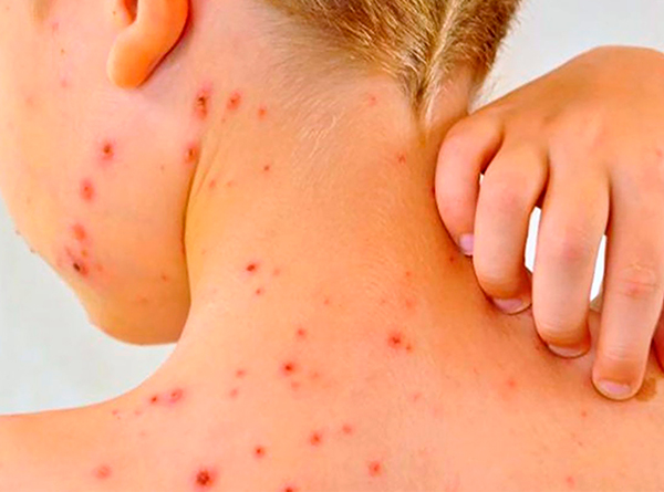 El secretario David Kershenobich aseguró que el brote de sarampión en México se encuentra en contención.