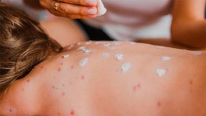 Las autoridades sanitarias monitorean el avance del sarampión en los 433 municipios afectados del territorio mexicano.